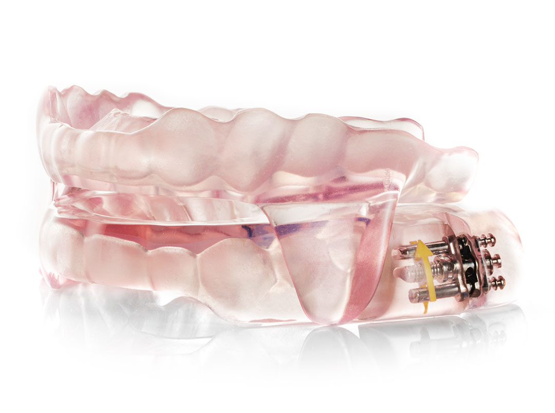 Photo of a sleep apnea sleep appliance