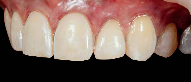 A photo of a mouth after receiving gum recession treatment