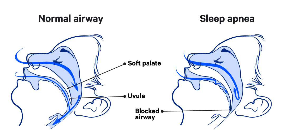 Illustration of of a head with sleep apnea, showing the airway passage.