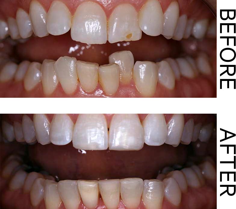 A Before and After showing the results of Siw Month Smiles, veneers, and tooth whitening. Image for the Gift of Great Smiles blog post.