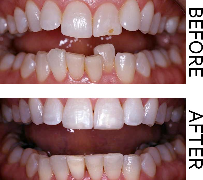 A Before and After showing the results of Six Month Smiles, veneers, and tooth whitening. Image for the Gift of Great Smiles blog post.