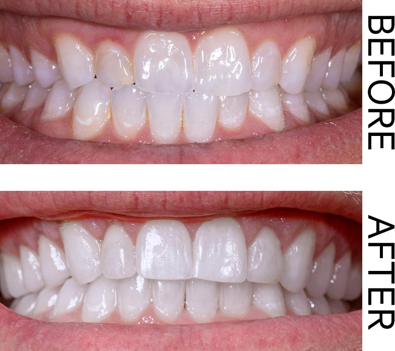 A Before and After showing the results of gum contouring. Image for the Gift of Great Smiles blog post.