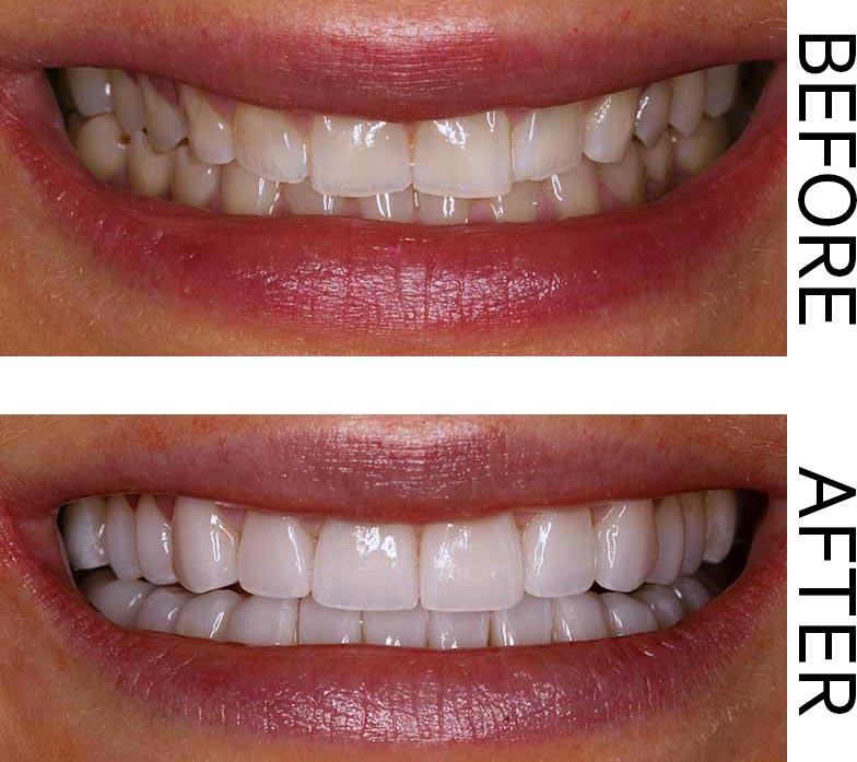 A Before and After showing the results of aesthetic veneers and brilliant teeth whitening. Image for the Gift of Great Smiles blog post.