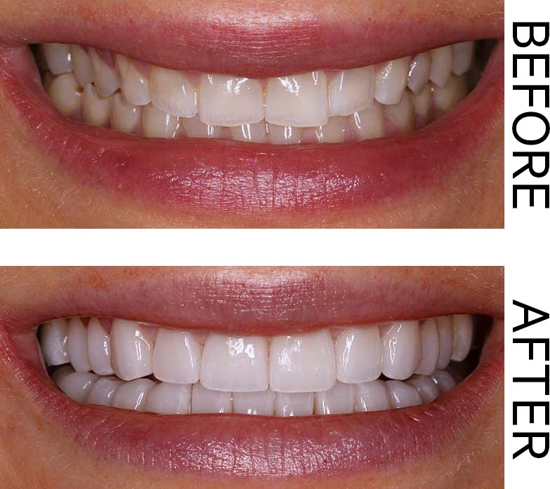 A Before and After showing the results of aesthetic veneers and brilliant teeth whitening. Image for the Gift of Great Smiles blog post.