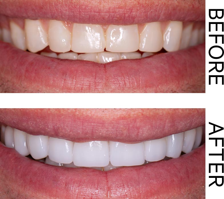 A Before and After showing the results of teeth whitening. Image for the Gift of Great Smiles blog post.