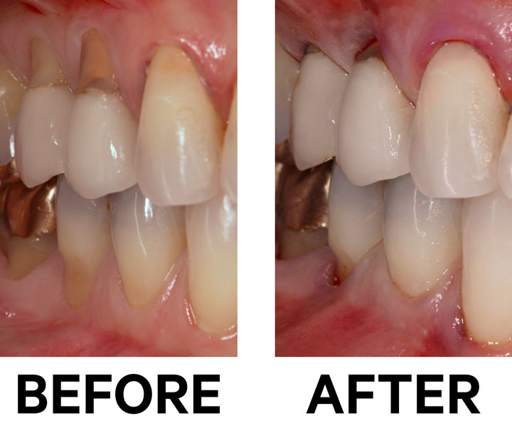 Before and after showing the results of correcting gum recession using the Chao Pinhole Technique.