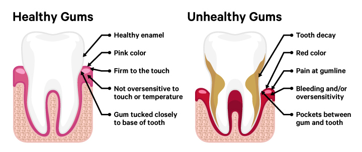 Diagram showing the difference between healthy and unhealthy gums for the Correcting Gum Recession blog post.