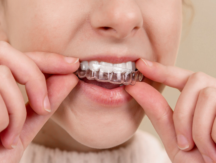 A woman puts on a daytime mouthguard to help protect against daytime teeth grinding.