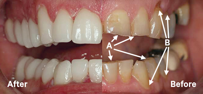 Image depicting a patient's smile showing the effects of stress and TMD.