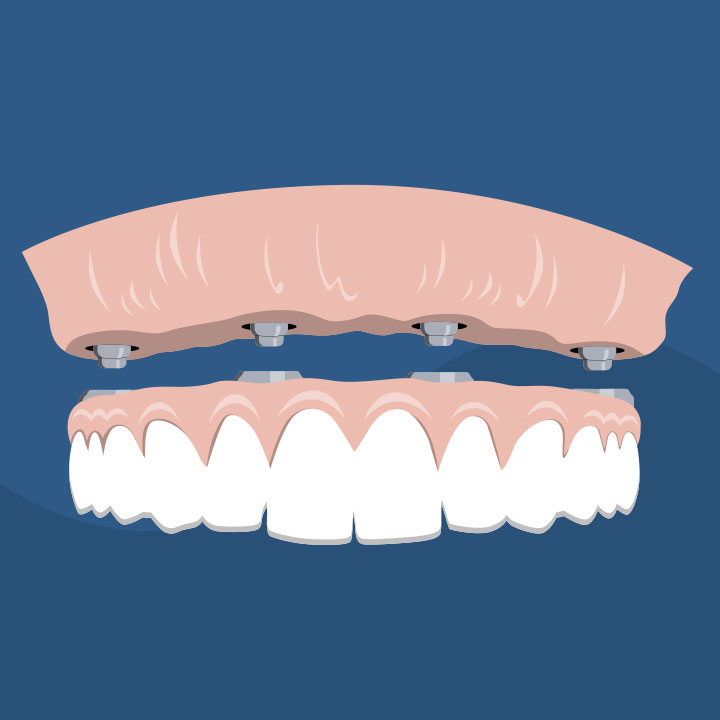 Illustration showing what one type of implant-supported denture looks like for the Skip Buyer's Remorse blog post.