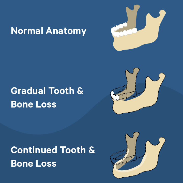 Diagram illustrating the effects of jaw bone loss for the Skip Buyer's Remorse blog post.