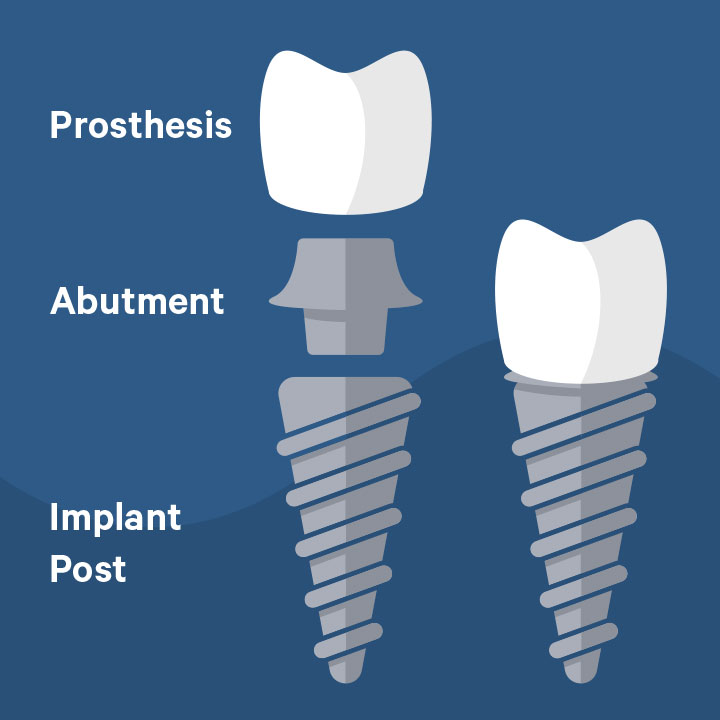 Diagram illustrating the three parts of a dental implant - the post, the abutment, and the prosthesis. Image for Skip Buyer's Remorse blog post.