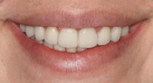 Smile Gallery page. After photo of Infinite Smiles client with dental crowns.