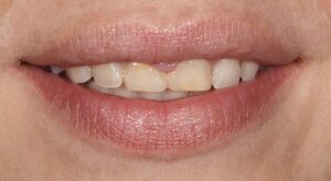 Smile Gallery page. Before photo of Infinite Smiles client with dental crowns.