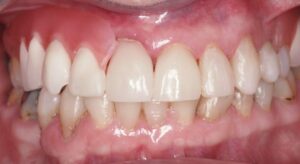 Smile Gallery page. After photo of Infinite Smiles client with implant supported bridge and veneers