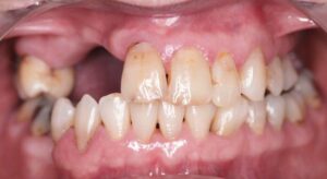 Smile Gallery page. Before photo of Infinite Smiles client with implant supported bridge and veneers