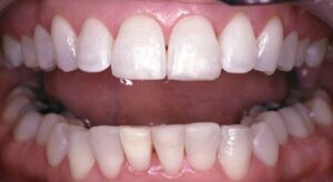 Smile Gallery page. 6 months smiles, veneers and whitening after photo