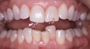 Smile Gallery page. 6 months smiles, veneers and whitening before photo