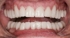 Smile Gallery page. After photo of Infinite Smiles client with dental crowns and implants.