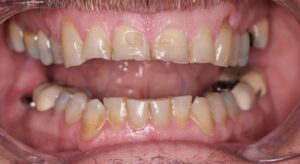 Smile Gallery page. Before photo of Infinite Smiles client with dental crowns and implants.