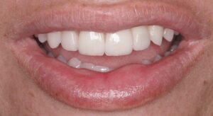 Smile Gallery page. Dental implants and veneers after photo