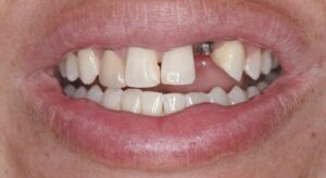 Smile Gallery page. Dental implants and veneers before photo