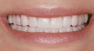 Smile Gallery page. After photo of Infinite Smiles client with veneers and whitening.