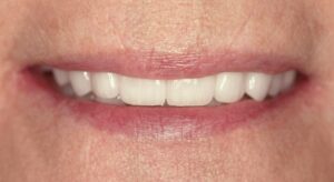 Smile Gallery page. After photo of Infinite Smiles client with implant supported dentures