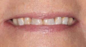 Smile Gallery page. Before photo of Infinite Smiles client with implant supported dentures