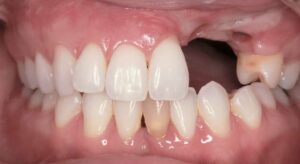 Smile Gallery page. Before photo of Infinite Smiles client with implant supported bridge and whitening.