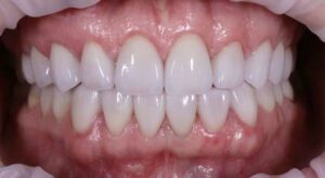 Smile Gallery page. Veneers after photo