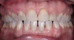 Smile Gallery page. Veneers before photo