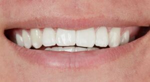 Smile Gallery page. After photo of Infinite Smiles client with 6 month smiles and whitening.