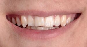 Smile Gallery page. Before photo of Infinite Smiles client with 6 month smiles and whitening.