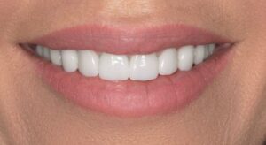 Smile Gallery page. After photo of Infinite Smiles client with veneers and dental crowns.