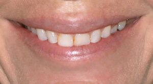 Smile Gallery page. Before photo of Infinite Smiles client with veneers and dental crowns.