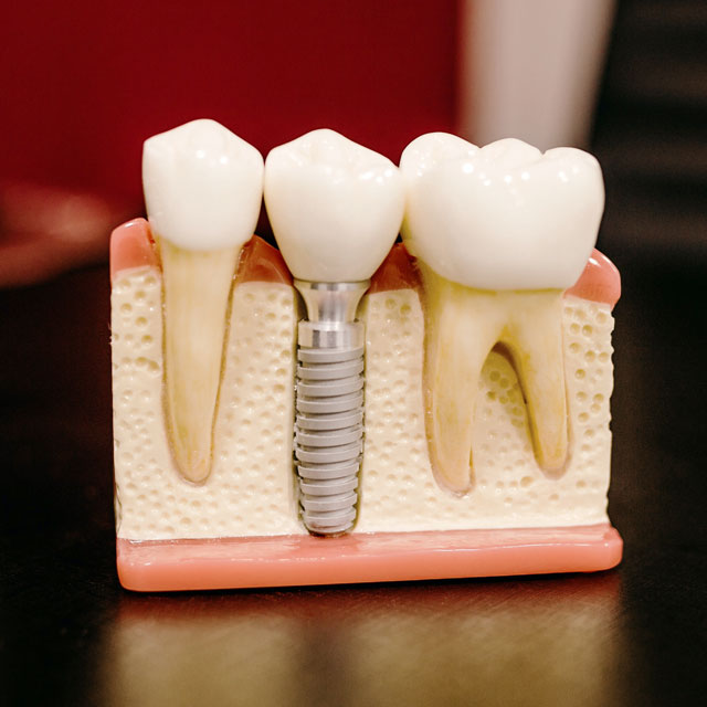 A cutaway model showing off how a dental implant works for the replace missing teeth blog post.