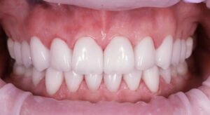 Smile Gallery page. Dental crowns, veneers and whitening after photo