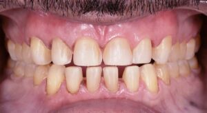 Smile Gallery page. Dental crowns, veneers and whitening before photo