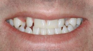 Smile Gallery page. Before photo of Infinite Smiles client with dental implants, crowns, veneers and whitening.