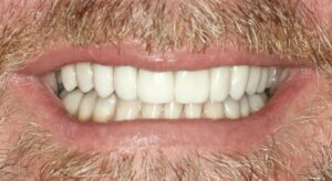 Smile Gallery page. Dental crowns and whitening after photo