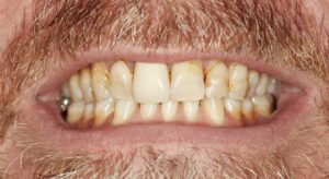 Smile Gallery page. Dental crowns and whitening before photo