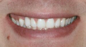 Smile Gallery page. Dental implants, veneers and whitening after photo