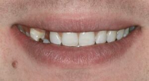 Smile Gallery page. Dental implants, veneers and whitening before photo