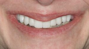 Smile Gallery page. Dental crowns and whitening after photo