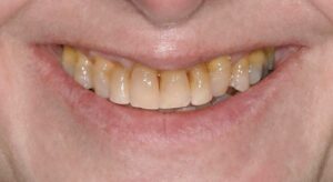 Smile Gallery page. Dental crowns and whitening before photo