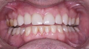 Smile Gallery page. After photo of Infinite Smiles client with dental implants and crowns.