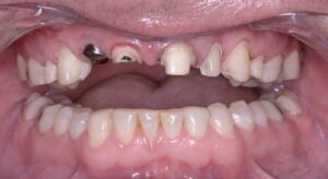 Smile Gallery page. Before photo of Infinite Smiles client with dental implants and crowns.