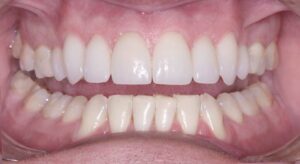 Smile Gallery page. After photo of Infinite Smiles client with dental crowns, veneers and whitening.