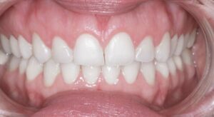 Smile Gallery page. Dental crowns, 6 months smiles and whitening after photo